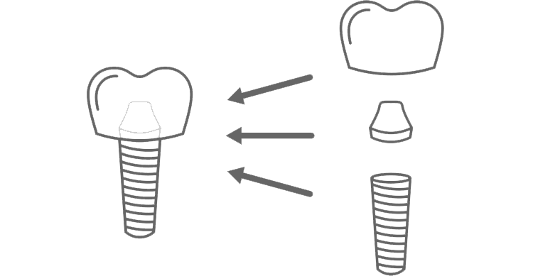 天然の歯と人工の歯の主な違い