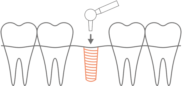 歯の根となるインプラントの埋入